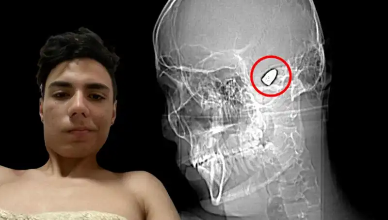 Kafasında Patlayıcı Bomba Taşıyan Adamın Hikayesi Şaşırttı